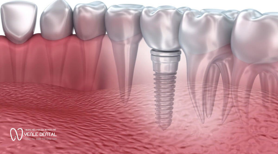 biến chứng trồng implant